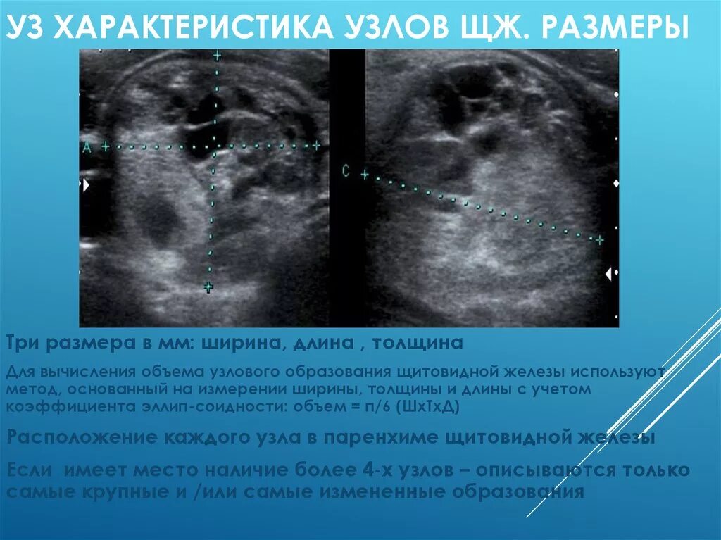 Щитовидная железа узлы в правой доле. Узловые образования долей щитовидной железы. Узловые образования щитовидной железы на УЗИ. Губчатый узел щитовидной железы на УЗИ. Узел в щитовидной железе на УЗИ.