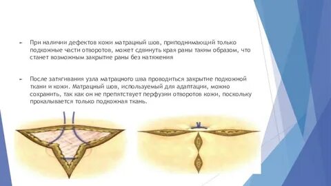 Закрытие дефекта
