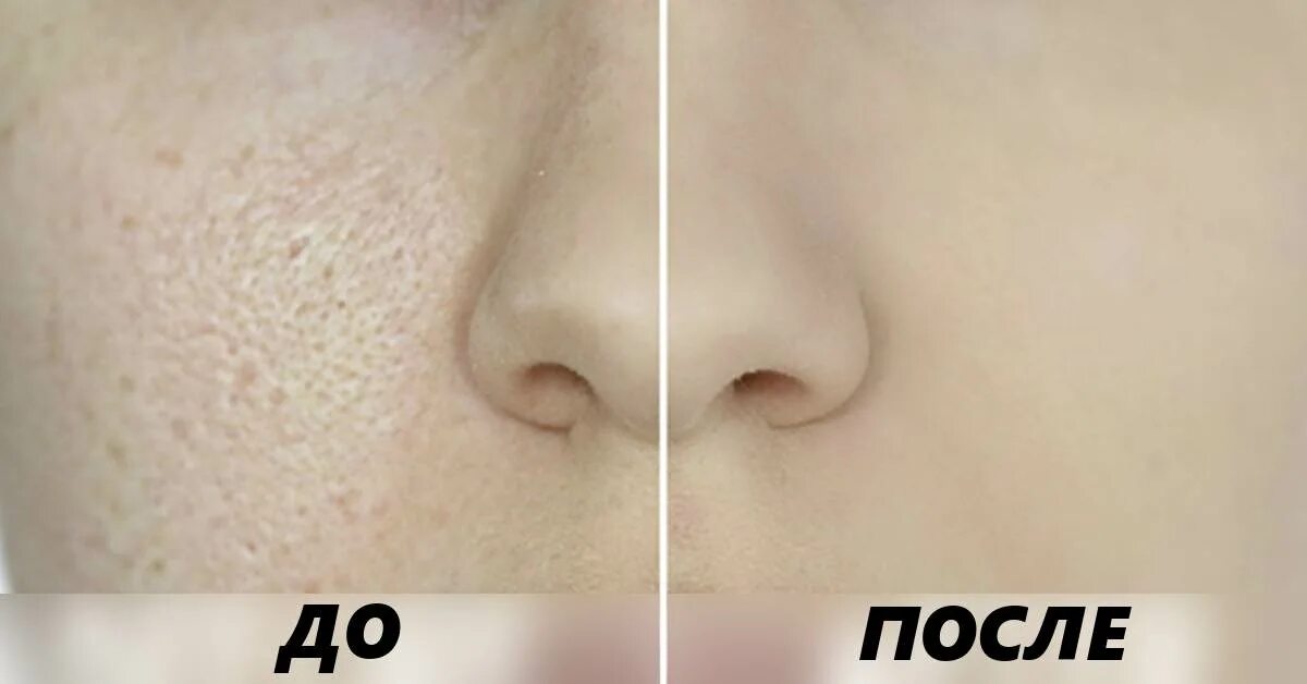 Фолликулярный гепертоз. Как закрыть поры. Как закрыть поры. Как закрыть поры. Праймер для лица для расширенных пор.