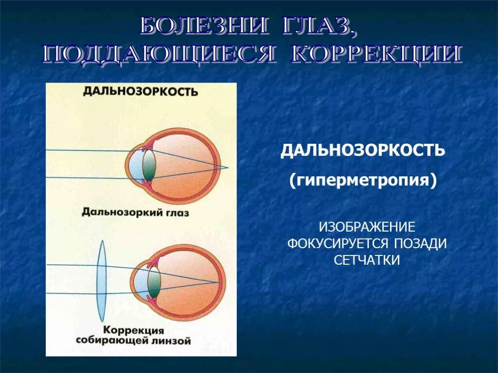 Болезнь дальнозоркость. Дальнозоркость глаз. При гиперметропии изображение фокусируется. Дальнозоркость изображение. Коррекция гиперметропии.