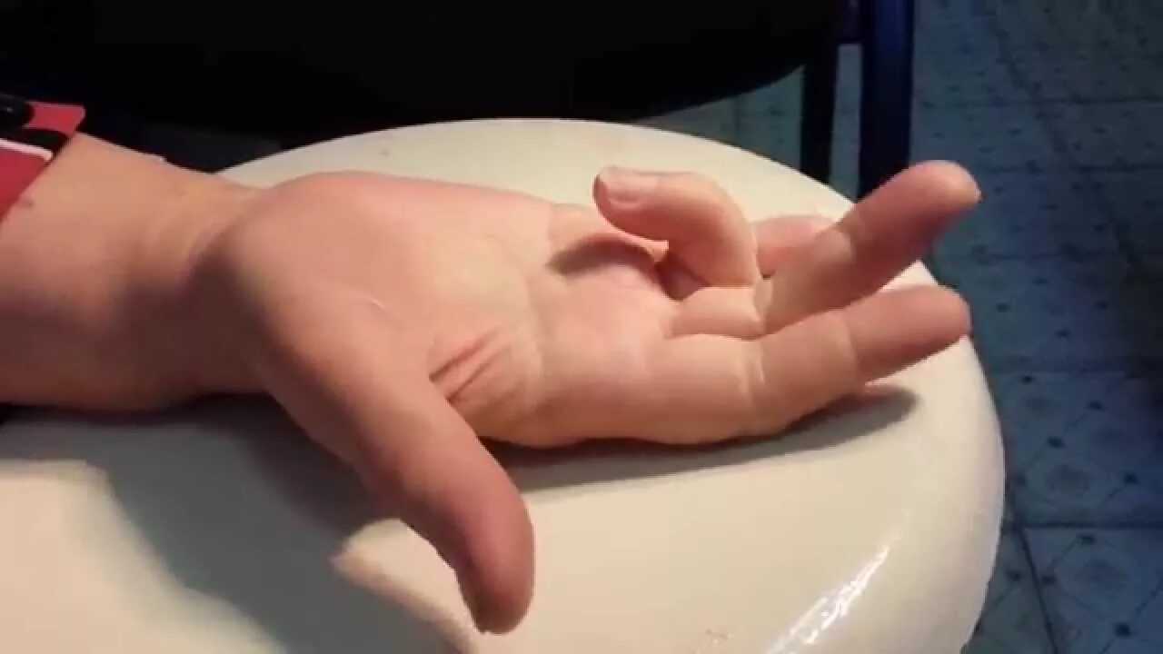 Щелкающий средний палец. Стенозирующий лигаментит 1 пальцев кистей. Стенозирующий лигаментит болезнь нотта операция. Стенозирующий лигаментит пальца кисти. Стенозирующий лигаментит болезнь нотта операция.