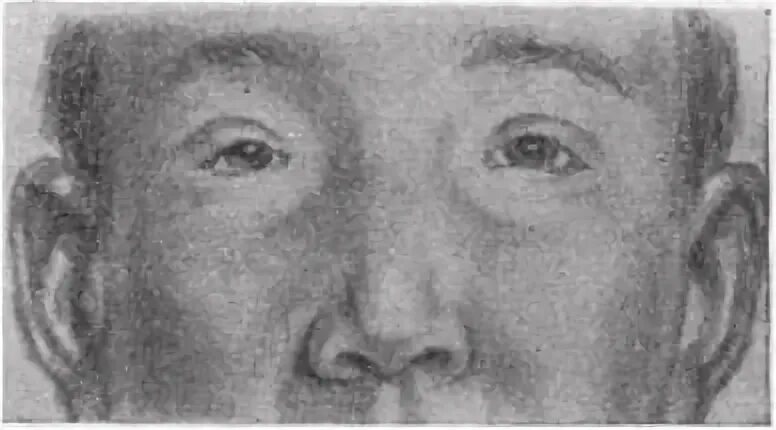 Узкая глазная щель. Врожденный блефарофимоз. Узкая глазная щель. Эмбриональный алкогольный синдром. Глаза монголоидной расы эпикантус.