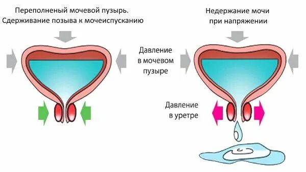 Непроизвольное Мочеиспускание У Женщин Во Время Секса