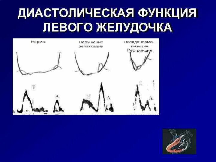 Диастолическая дисфункция это. Типы нарушения диастолической функции лж. диастолическая дисфункция левого желудочка е/а. диастолическая функция левого желудочка. систолическая и диастолическая функция левого желудочка.