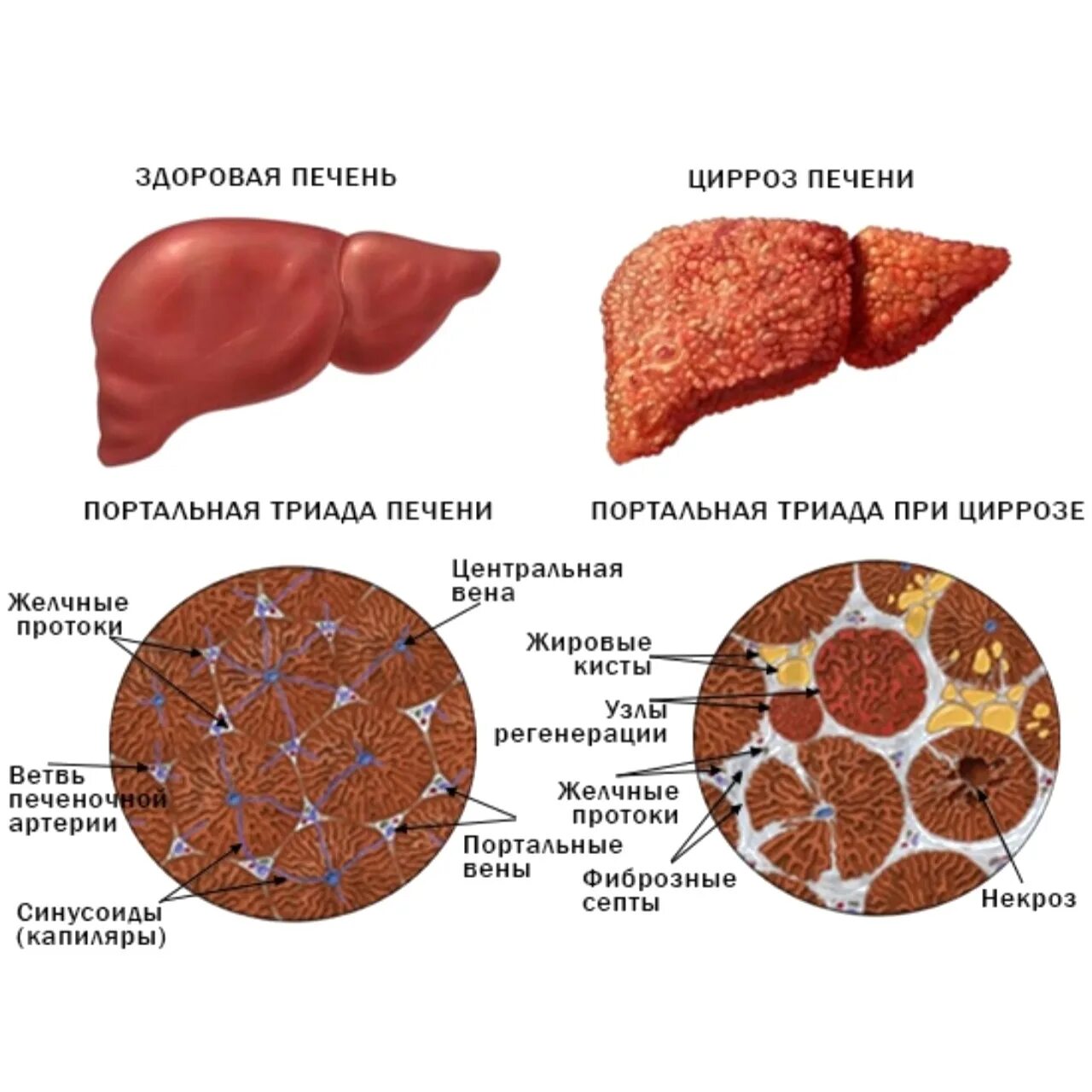 Цирроз печени строение. Изменения печени при циррозе. Цирроз печени патанатомия. Цирроз печени патанатомия животных. Гепатоз алкогольный лечение