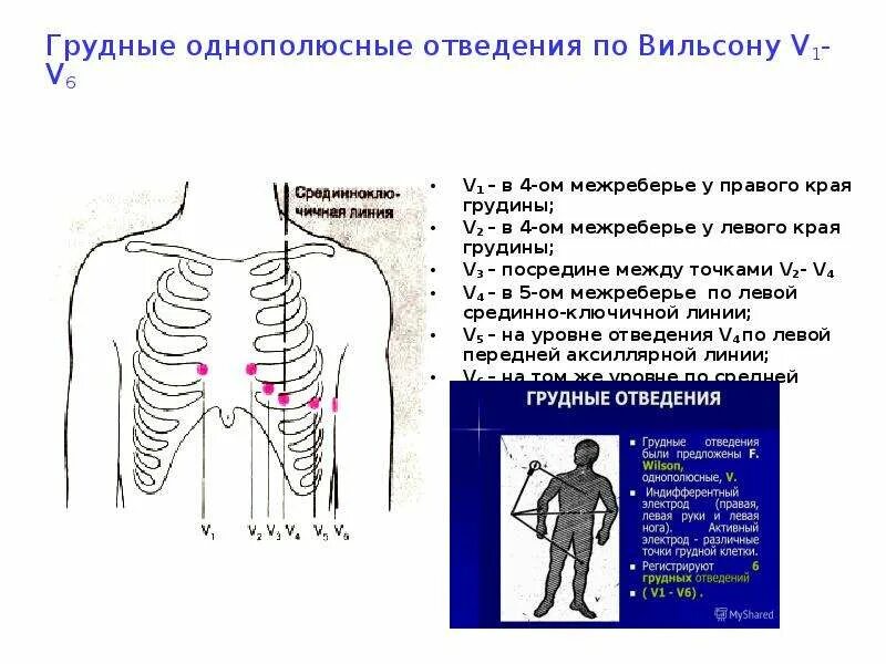 В V межреберье у левого края грудины. 4 Межреберье спереди у детей до года. Левые и правые грудные отведения на ЭКГ. Электроды ЭКГ на грудной клетке. Правые грудные отведения