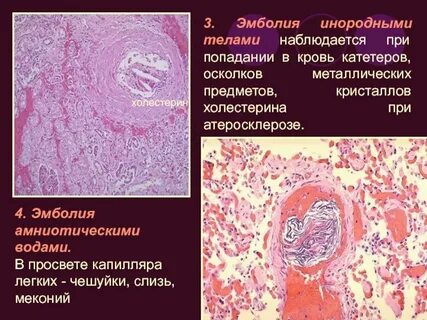 Эмболия это