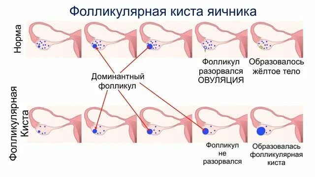 Фолликулярная киста яичника на кт. Фолликулярная киста яичника на узи. Фолликулярная киста правого яичника. Фолликулярная киста яичн. Перекрутка кисты яичника.