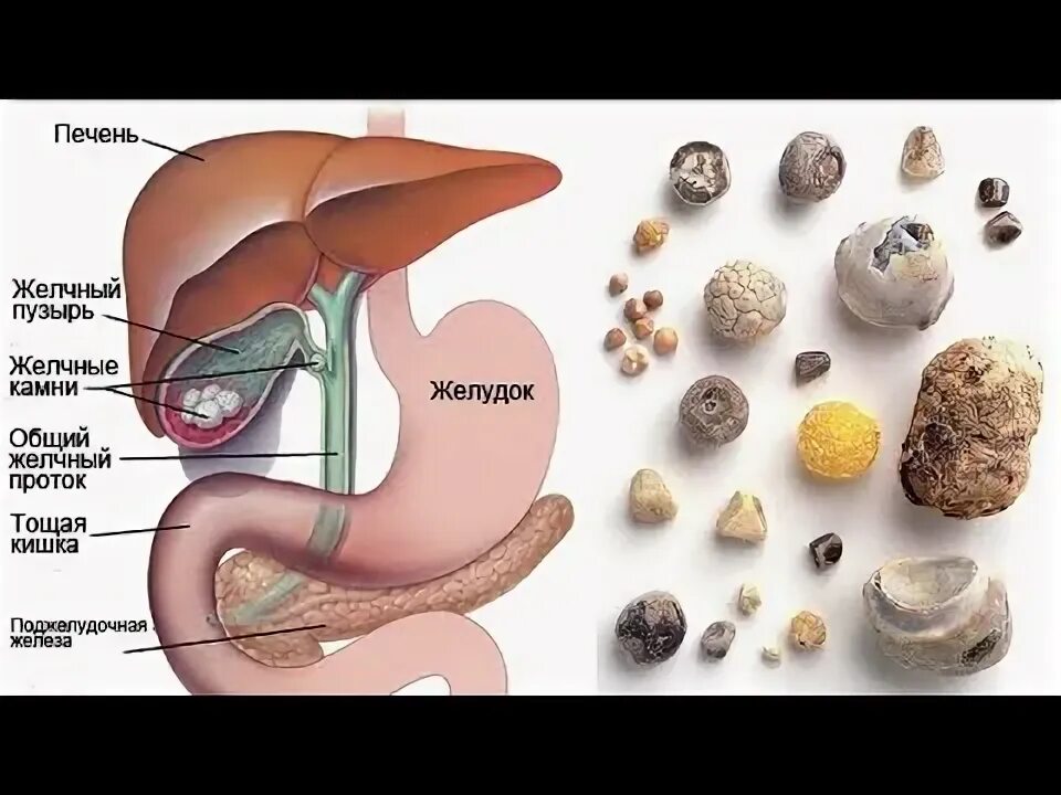 Растворяются ли камни. Растворить камни в желчном пузыре.