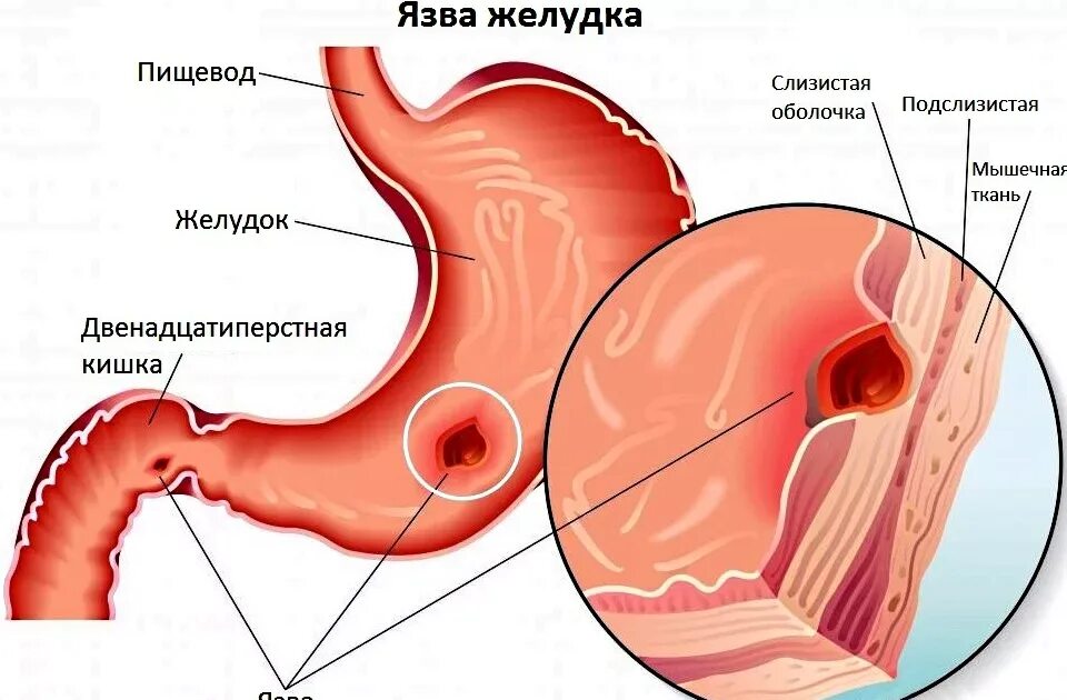 Проявления язвенной болезни желудка и 12-перстной кишки.. Язвенная болезнь желудка язвенная болезнь 12 перстной кишки. Язвенная болезнь желудка и 12 перстной кишки. Язва 12 ти