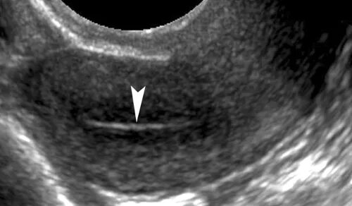 УЗИ картина полипа эндометрия. Синехии эндометрий на УЗИ. Ретроцервикальный эндометриоз на УЗИ. Можно делать узи перед месячными