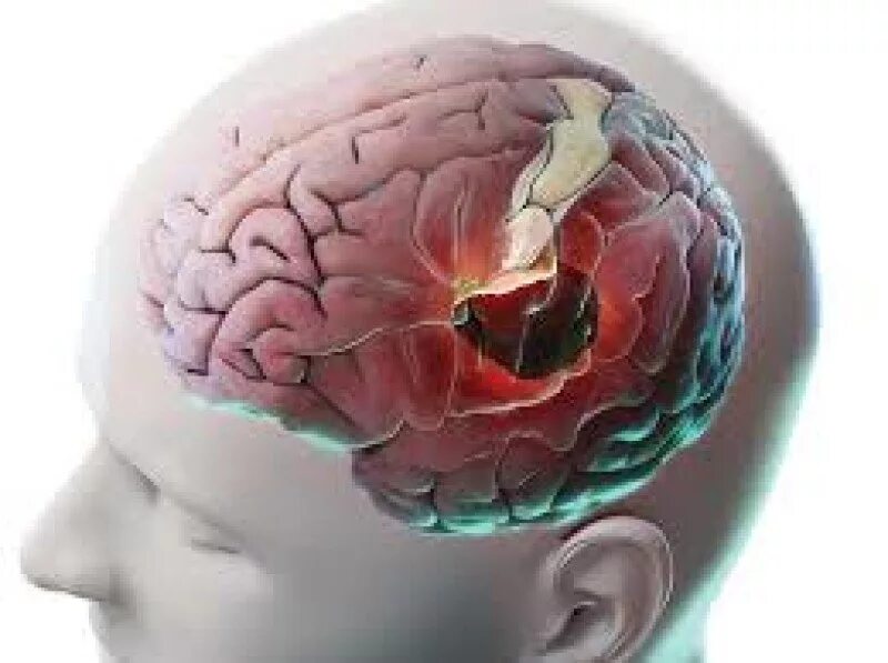 Удар мозга последствия. Повреждение головного мозга. Повреждения головы и головного мозга.. Контузия головного мозга. Мозг в голове.