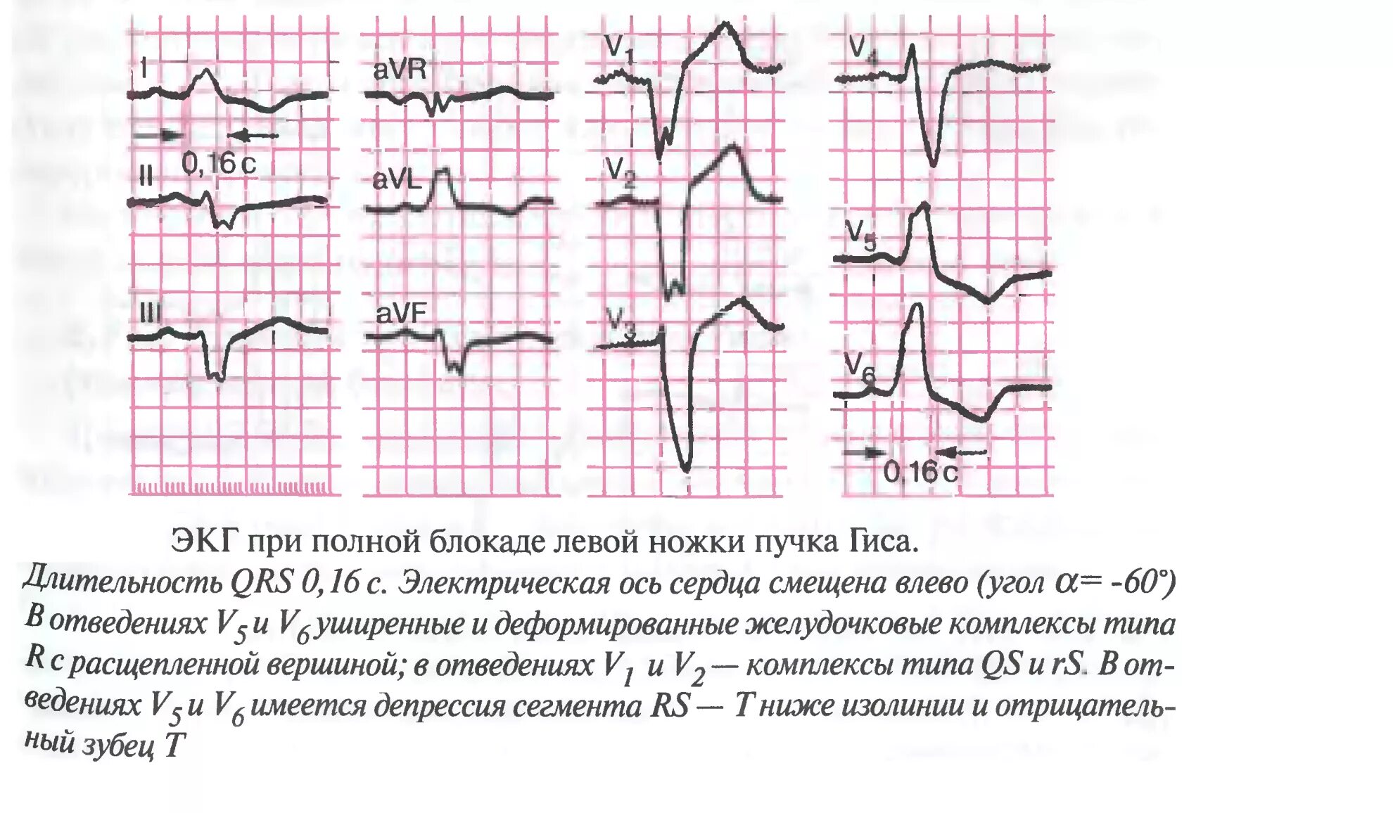 Блокада ЛНПГ на ЭКГ. Блокада правой ножки пучка Гиса на ЭКГ. Блокада ножек пучка Гиса на ЭКГ. Неполная блокада левой ножки пучка Гиса на ЭКГ. Блокада правой ножки желудочка
