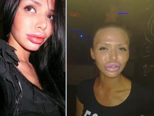 Самые большие губы ботокс. Силиконовые губы. Девушка с перекаченными губами. Красивое увеличение губ. Девушки с неувеличенными губами.