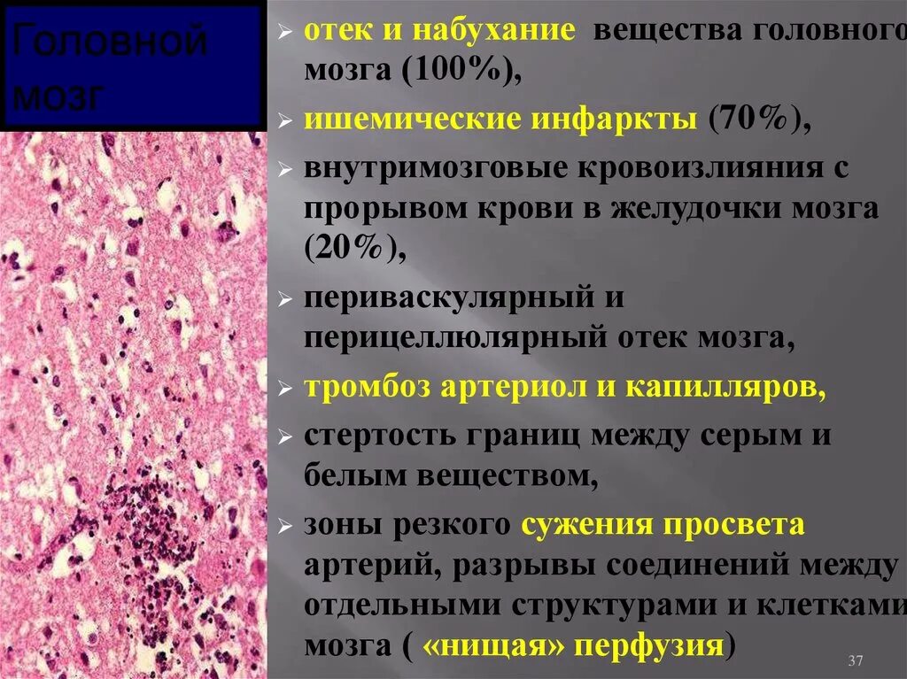 Размягчение головного мозга. Ишемический инфаркт головного мозга гистология. Геморрагический инфаркт головного мозга патанатомия. Периваскулярный отек головного мозга. Отёк головного мозга патанатомия.