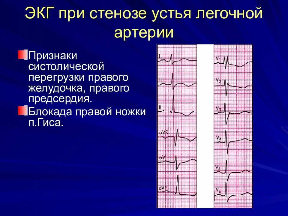 Блокада правого желудочка. Тромбоэмболия легочной артерии на ЭКГ. ЭКГ недостаточность клапана легочного ствола. ЭКГ при стенозе клапана легочной артерии. ЭКГ при легочном стенозе.