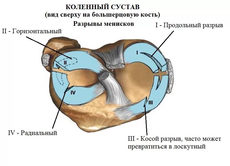 Повреждение переднего рога латерального мениска. Разрыв рога медиального мениска коленного сустава заднего 1 степени. разрыв заднего рога медиального мениска мениска. горизонтальный разрыв заднего рога медиального мениска. продольный горизонтальный разрыв мениска.