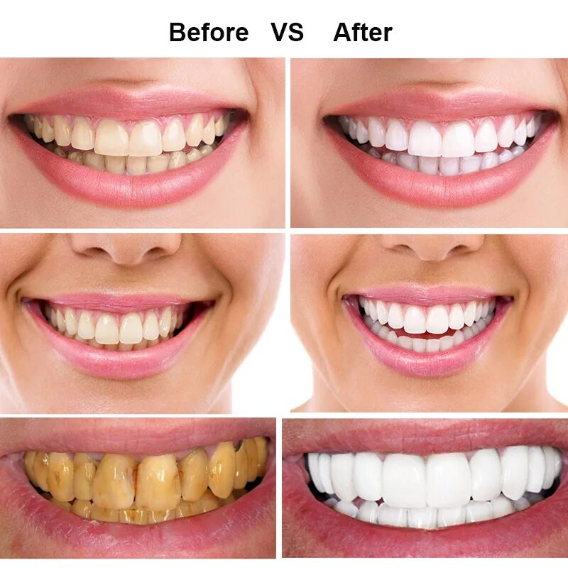 Отбеливание зубов. Отбеливание зубов до и после. Зубы до и после отбеливания.