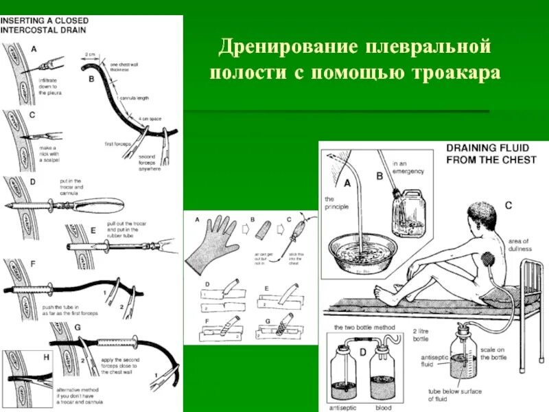 Методика дренирования плевральной полости. Техника пункции и дренирования плевральной полости. Дренирование полости плевры. Показания к дренированию плевральной полости.