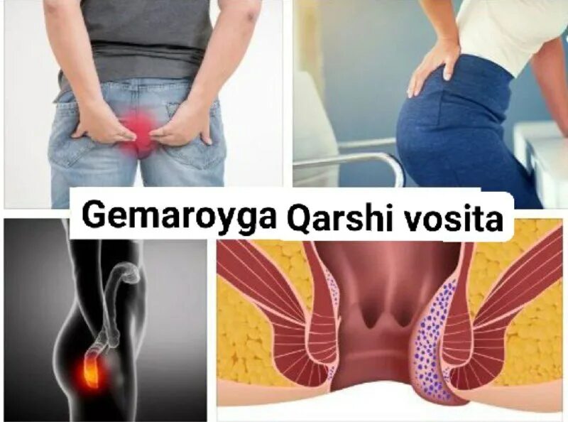 Основные причины геморроя. Предпосылки возникновения геморроя. Можно ли бегать при геморрое. Упражнения в тренажерном зале при геморрое. Клинические проявления геморроя.