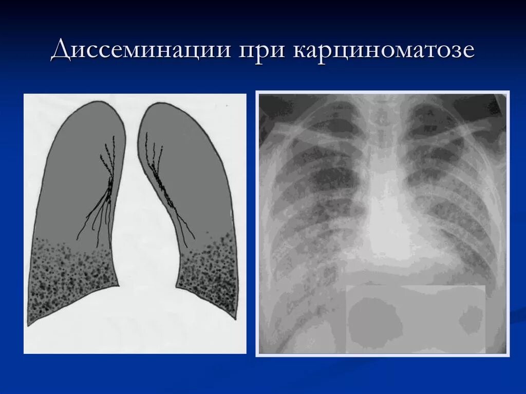 Милиарный диссеминированный туберкулез рентген. Диссеминированный туберкулёз лёгких рентген. Диссеминированный туберкулез на кт. Диффузный рак легких