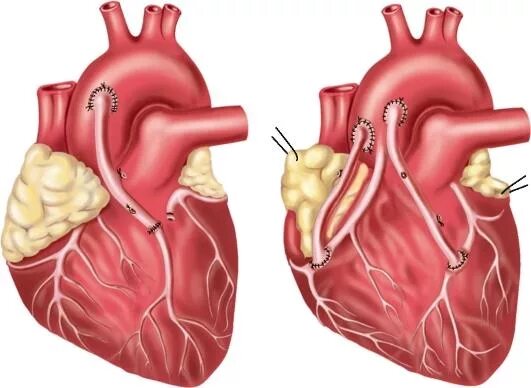Аорта....аортокоронарное...шунтирование. Коронарное шунтирование сосудов сердца. Шунтирование коронарных артерий сердца. Операция на сердце коронарное шунтирование. Как делают коронарное шунтирование