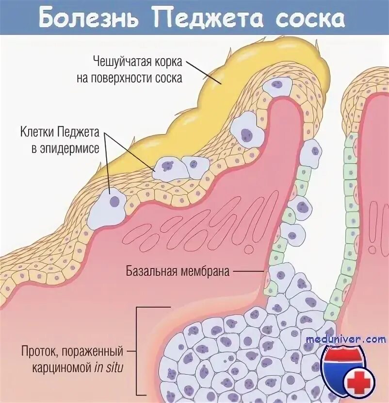 Как выглядит рак соска Рак Педжета молочной железы Рак лечение и профилактика