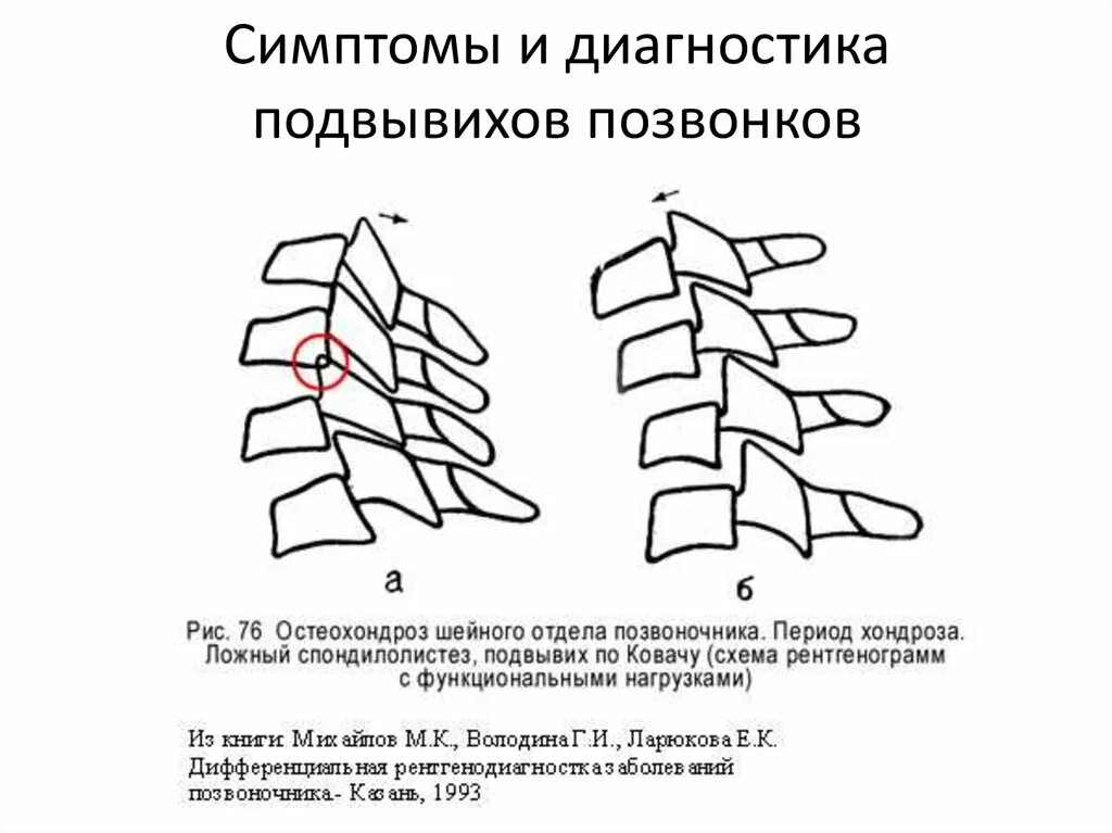 Подвывих по ковачу. Подвывих с1 позвонка рентген. подвывих с1 шейного позвонка рентген. подвывих по ковачу с4 с5. ротационный подвывих с2 позвонка.