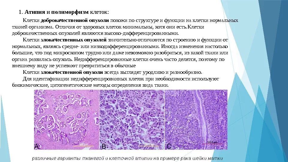 Клетка доброкачественной опухоли. Клетки злокачественной опухоли эпителиальной. Доброкачественная опухоль патанатомия. Полиморфизм строения злокачественной опухоли. Доброкачественная опухоль гистология.