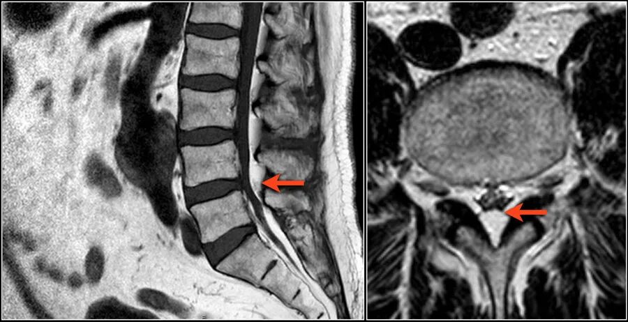 Грыжа мозговых оболочек освобождение нерва. Спинальный эпидуральный липоматоз. Эпидуральный липоматоз поясничного отдела мрт. Стеноз шейного отдела позвоночника мрт. Стеноз поясничного отдела позвоночника мрт.