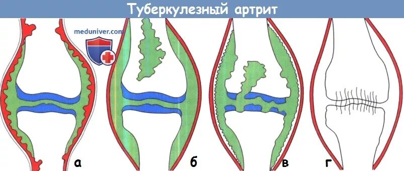 Туберкулезный остеоартрит. Стадии туберкулезного артрита. Ревматоидный артрит активность 1. Ревматоидный артрит туберкулез. Ревматоидный артрит туберкулез.