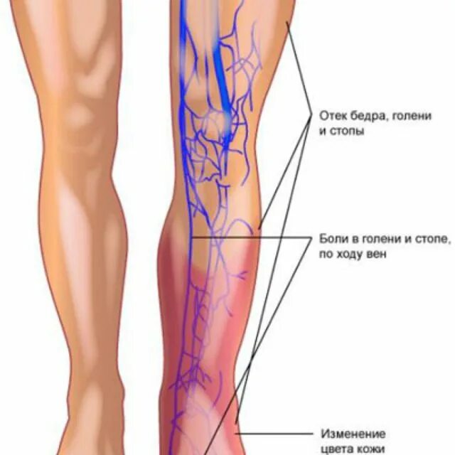 Флебит тромбофлебит флеботромбоз. Тромбофлебит поверхностных вен голени симптомы. Тромбофлебит бедренной вены. Поверхностная бедренная Вена тромбоз. Став тромбы
