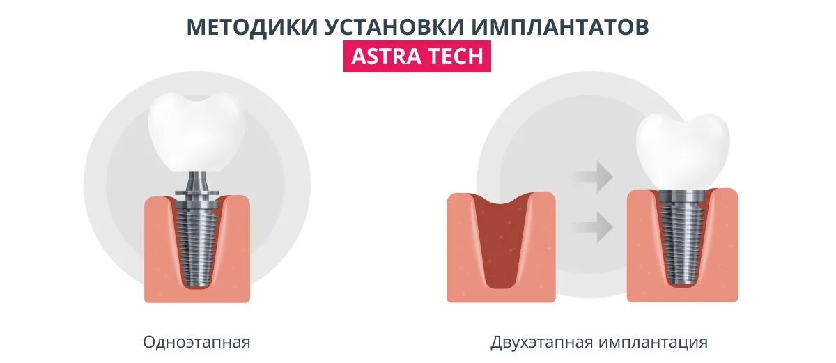 Зубы импланты поэтапно. Одноэтапная методика имплантации. Одноэтапная и двухэтапная имплантация. Одноэтапная и двухэтапная имплантация зубов. Двухэтапная имплантация зубов показания и противопоказания.