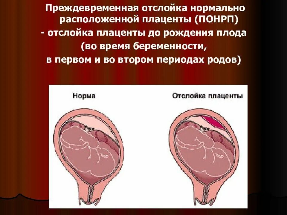 Отслоение плаценты на поздних сроках. Преждевременная отслойка нормально расположенной плаценты. осложнения преждевременной отслойки плаценты. отслойка нормальной расположенной плаценты. отслойка нормально расположенной плаценты симптомы.