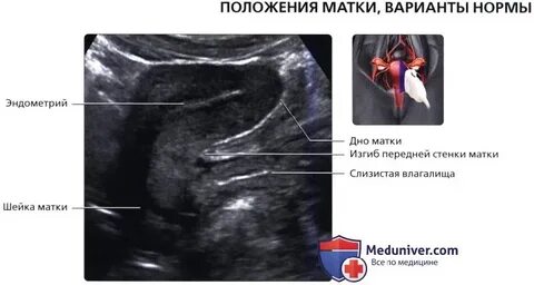 Anteflexio матка что значит
