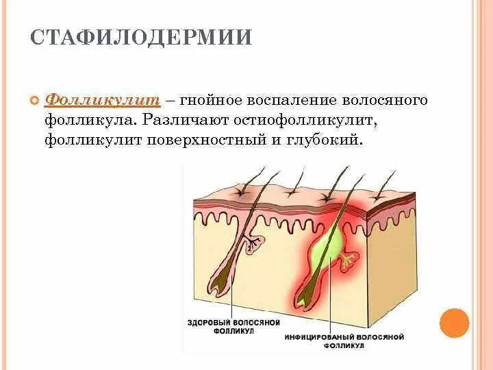 Плотный появление. Фолликулит – воспаление волосяных фолликул.. Поверхностный фурункул. Фолликулит фурункул карбункул.