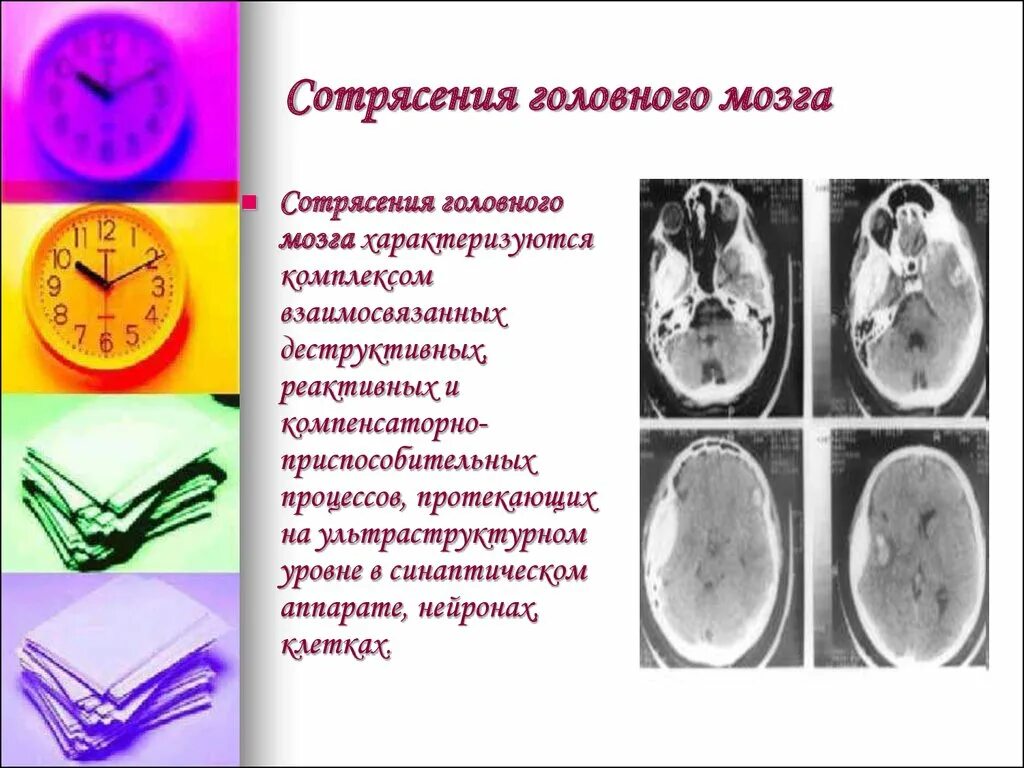 Сотрясение головного мозга. Черепно-мозговая травма сотрясение головного мозга. Сотрясение мозга патогенез. Сотрясение головного мозга характеризуется. Виды сотрясений