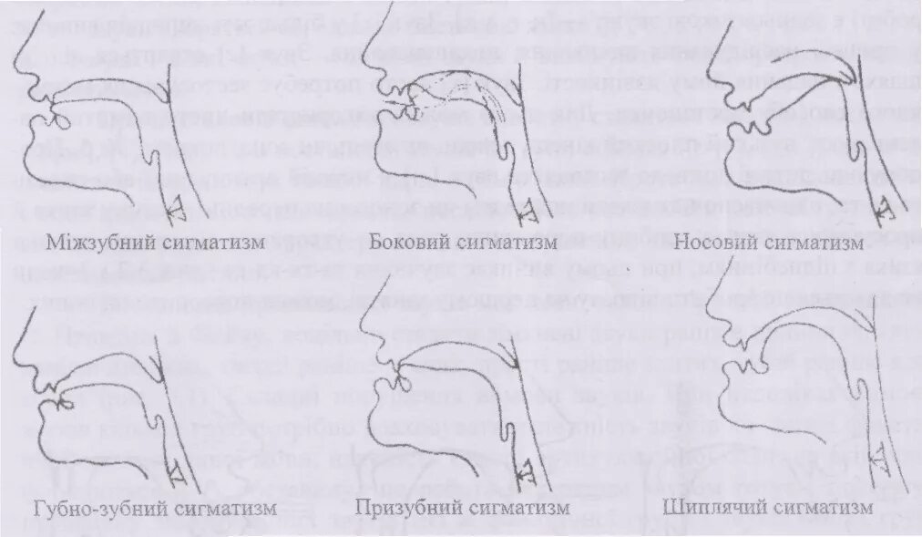 Звук правильно неправильно. Профили артикуляции свистящих звуков при ринолалии. Губно-зубной сигматизм свистящих звуков. Нарисуйте профили артикуляции свистящих звуков при ринолалии. Межзубный сигматизм артикуляция.