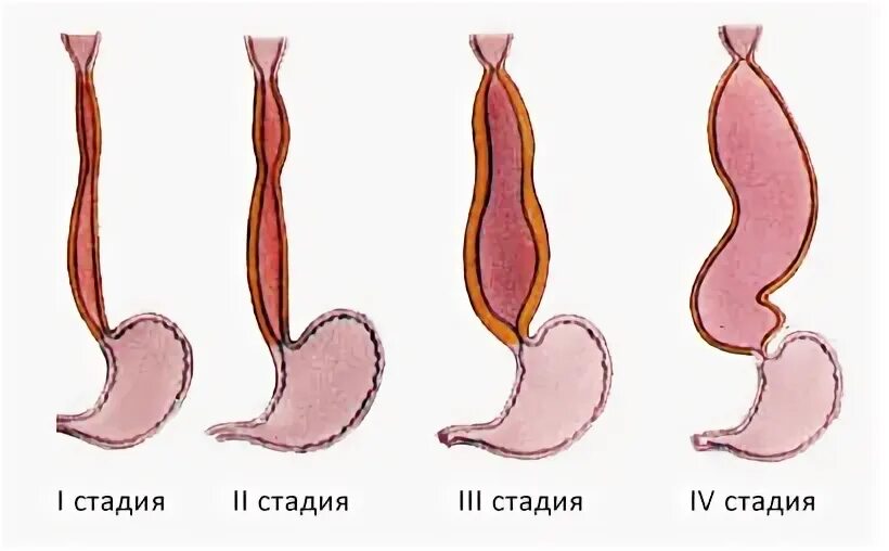 Пищевода 1 степени. Патогенез ахалазии кардии. Ахалазия кардии пищевода этиология. Халазия и ахалазия кардии. Ахалазии кардии 2 степени.