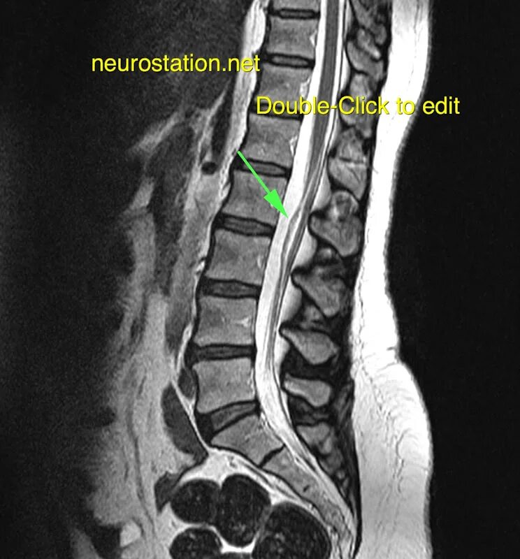 Эпидуральный липоматоз. Липома терминальной нити спинного мозга. Липома поясничного отдела позвоночника мрт. Липома терминальной ни мрт.