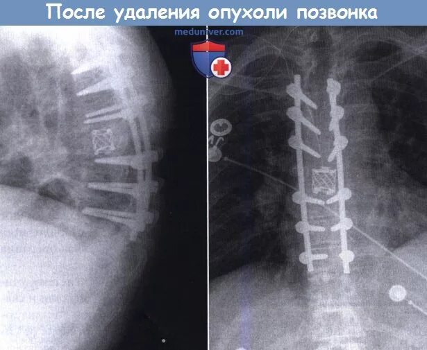 Новообразования позвоночника. Метастазы в позвоночнике на снимке. Метастазы в грудном отделе. Отек позвоночника после операции