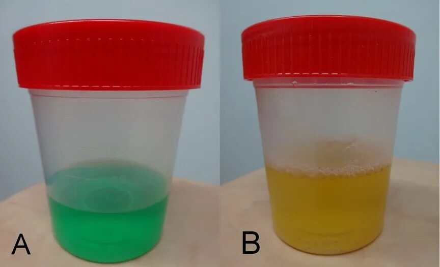 Зеленая моча. Зеленоватая моча. Моча зеленого цвета. Окрашивание мочи в салатовый цвет.