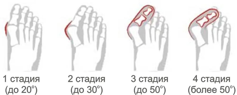 Первая стадия. Вальгусная деформация 1 пальца степени рентген. Степени деформации 1 пальца стопы степени вальгусной. Вальгусная деформация 1 пальца 1 степени.