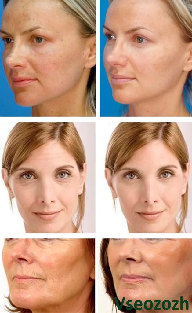 Плазмолифтинг для лица. Плазмолифтинг какой эффект. Плазмотерапия лица до и после. Схема уколов плазмолифтинг. Плазмолифтинг какой эффект.