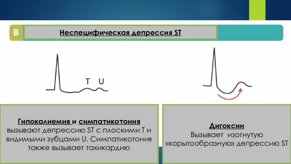 Депрессия сегмента st. Корытообразная депрессия сегмента St. Депрессия сегмента St v3 v5. Депрессия сегмента St на ЭКГ типична для. Депрессия сегмента St на ЭКГ v5 v6.