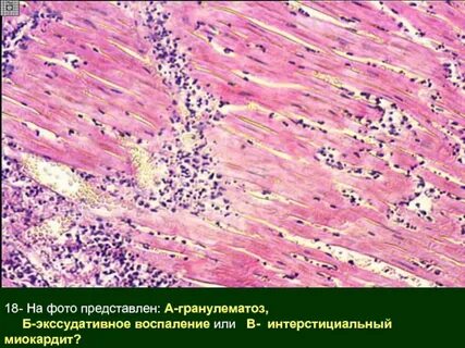 Очаговое гнойное воспаление