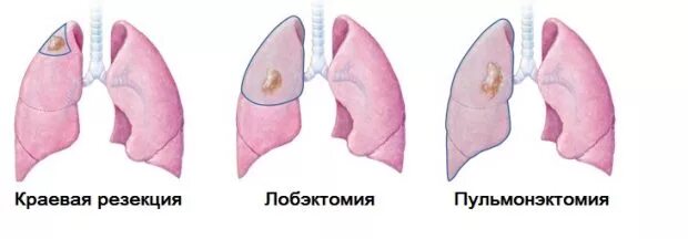 Операция лобэктомия верхней доли левого легкого. Отсутствие легкого на рентгенограмме. После удаления левого легкого. Удаление доли легкого операция. Лобэктомия верхней доли правого легкого.
