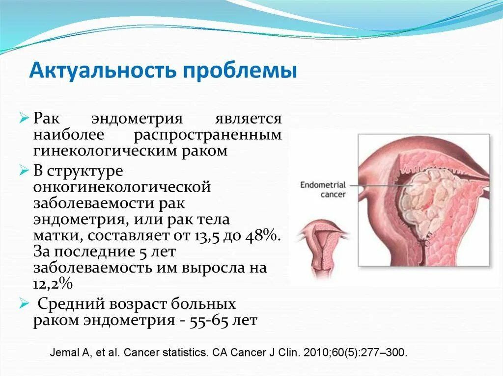 Рак 0 матки. Опухоль эндометрия матки. Опухоли тела матки классификация.