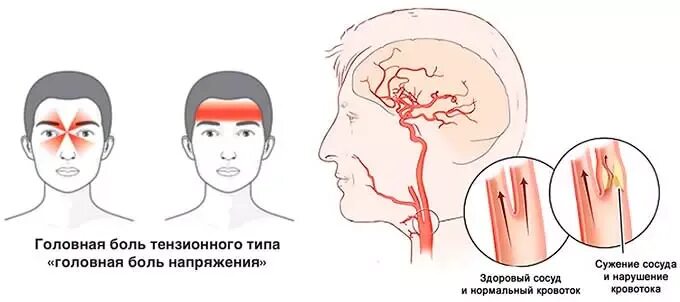 Напряжение головных мышц. Головная боль напряжения перикраниальных мышц. головная боль напряженного типа. тензионный тип головной боли. напряженный тип головной боли.