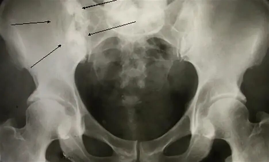 Остеобластические метастазы рентген. Метастаз подвздошной кости рентген. Опухоль подвздошной кости рентген. Остеобластические метастазы в кости таза рентген.